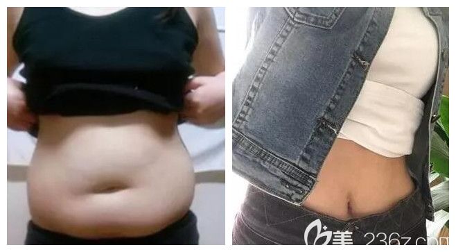 南寧夢(mèng)想整形唐超醫(yī)生腰腹部吸脂案例 南寧夢(mèng)想整形唐超醫(yī)生腰腹部吸脂案例