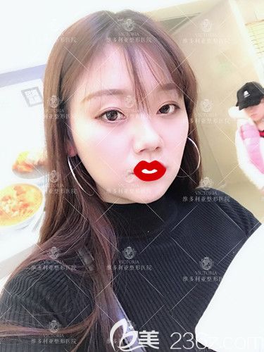 李成輝醫(yī)生為我做面部脂肪填充術(shù)后15天面部消腫