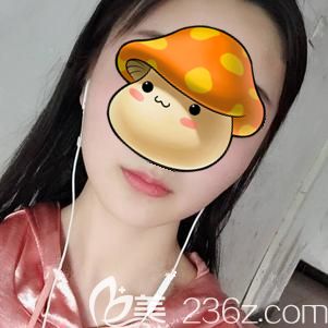 做假體墊下巴術(shù)后7天拆線腫脹消除