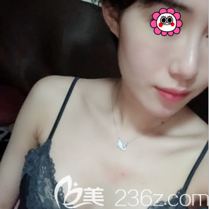 高超醫(yī)生給我做假體內(nèi)窺鏡隆胸第21天樣子