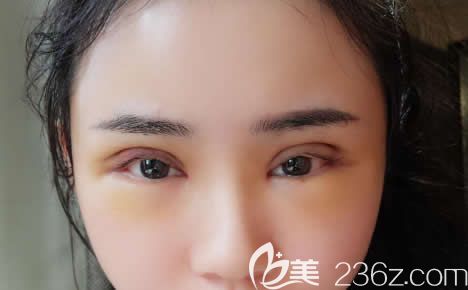 做完全切雙眼皮7天恢復(fù)<span style= 做完全切雙眼皮7天恢復(fù)<span style=