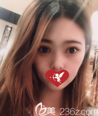 講述我找遼寧曙光整形外科做埋線雙眼皮+開(kāi)眼角綜合手術(shù)過(guò)程及術(shù)后30天恢復(fù)效果圖！