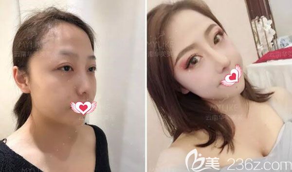 美萊肋軟骨隆鼻+硅膠隆鼻案例效果