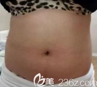 我在南寧美麗星整形做腰腹部吸脂前 我在南寧美麗星整形做腰腹部吸脂前