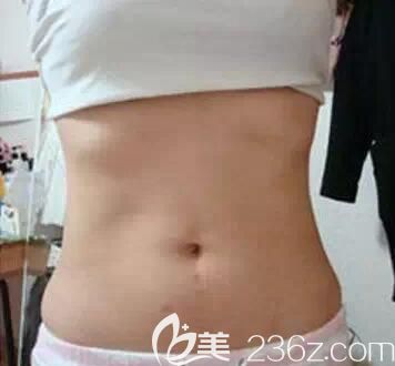 找南寧芯玥整形醫(yī)生做水動(dòng)力腰腹部環(huán)形吸脂一個(gè)月后，成功甩掉“游泳圈”