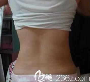 我在南寧美麗星做腰腹部吸脂1個(gè)月 我在南寧美麗星做腰腹部吸脂1個(gè)月