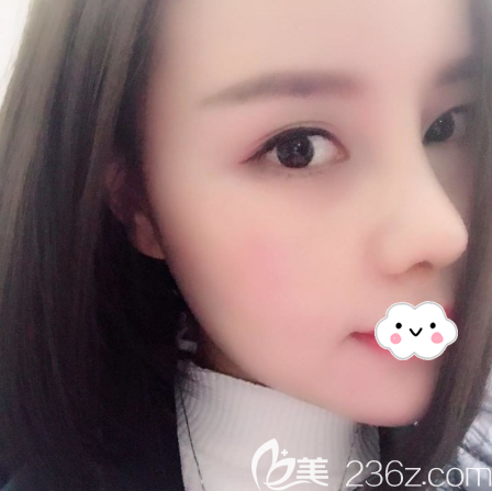 肋軟骨鼻綜合隆鼻術(shù)后15天恢復(fù)過(guò)程圖