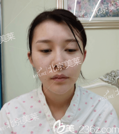 <!--<i data=20240703-sp></i>-->醫(yī)生給我做PRP全臉脂肪填充手術(shù)前照