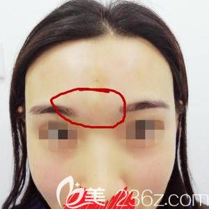 剛注射完的照 剛注射完的照