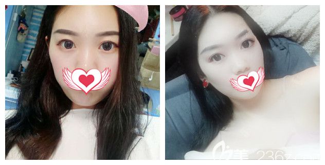 告別初老從南京藝星內(nèi)切法去除遺傳眼袋開始，術(shù)后一個月填充了自體脂肪填充，后續(xù)還做了小氣泡美膚清潔