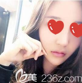 在斯美諾做玻尿酸填充面部術后2天效果 在斯美諾做玻尿酸填充面部術后2天效果