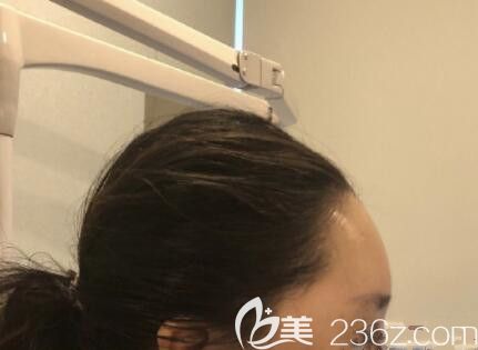 額頭骨水泥填充功課了韓國(guó)愛(ài)婷雕刻，選擇bonps相比脂肪填充我傾向于骨水泥