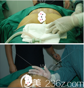 王沛森醫(yī)生給我做脂肪豐臀手術(shù)中