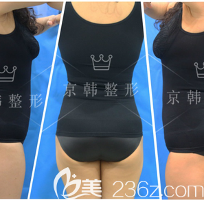 北京京韓王沛森自體脂肪豐臀案例