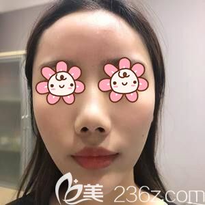 在長沙注射玻尿酸豐額頭術(shù)后即刻效果 在長沙注射玻尿酸豐額頭術(shù)后即刻效果