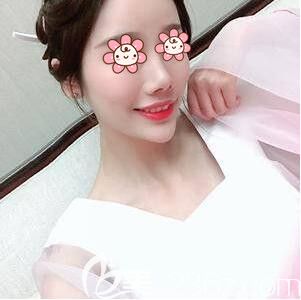 在長沙藝星注射玻尿酸豐額頭術(shù)后半個(gè)月效果圖 在長沙藝星注射玻尿酸豐額頭術(shù)后半個(gè)月效果圖