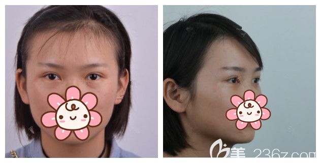 術(shù)前面診南京韓辰醫(yī)生眼袋明顯 術(shù)前面診南京韓辰醫(yī)生眼袋明顯