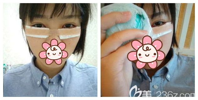 剛做完眶隔脂肪釋放法祛眼袋包扎冰敷 剛做完眶隔脂肪釋放法祛眼袋包扎冰敷