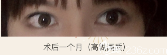 下至功課來啦說說我在韓國k整形做埋線眼角下至修復(fù)經(jīng)歷像個假手術(shù)無恢復(fù)期