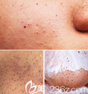 如何消除黑頭？皮膚反復(fù)長(zhǎng)黑頭原因