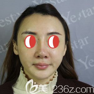 到武漢藝星做鼻部修復術(shù)前自己的鼻子 到武漢藝星做鼻部修復術(shù)前自己的鼻子