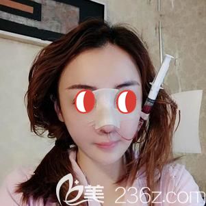 楊國梁院長幫我做鼻部修復術(shù)后即刻 楊國梁院長幫我做鼻部修復術(shù)后即刻