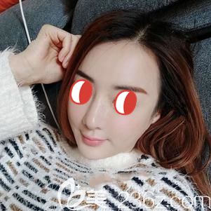 做鼻部修復術(shù)后15天腫脹消除疤痕漸消 做鼻部修復術(shù)后15天腫脹消除疤痕漸消