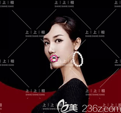 北京上上相鄭楚蓉全臉脂肪填充案例