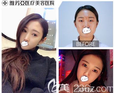 石家莊雅芳亞雙眼皮整形案例 石家莊雅芳亞雙眼皮整形案例