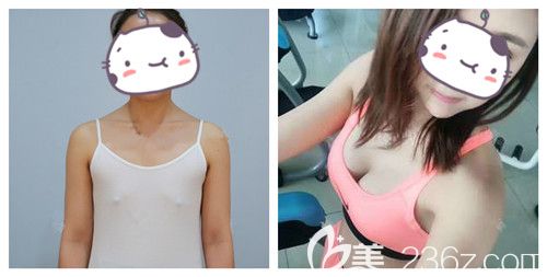 雅芳亞整形隆胸案例 雅芳亞整形隆胸案例