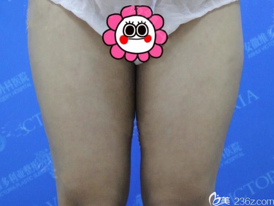 找安徽維多利亞衛(wèi)愛(ài)俠做大腿吸脂前 找安徽維多利亞衛(wèi)愛(ài)俠做大腿吸脂前