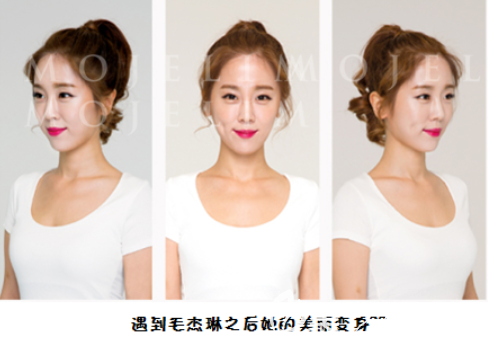 韓國毛杰琳額頭縮小2cm發(fā)際線矯正1600毛終于獲得了女性自然發(fā)際線