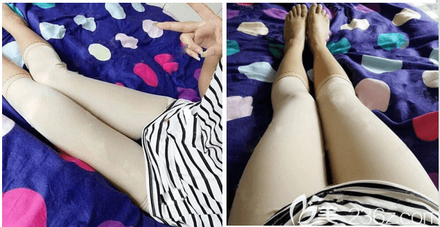 龐東亮醫(yī)生給我做大腿吸脂半個(gè)月效果