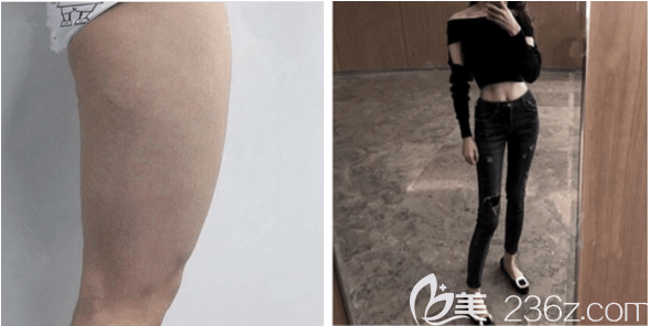 北京上上相龐東亮大腿吸脂前后對(duì)比效果圖