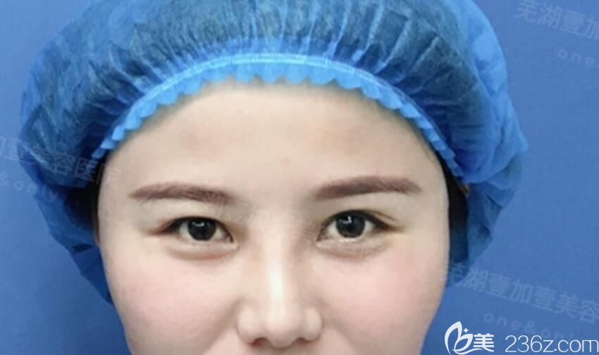埋線雙眼皮失敗后的照片 埋線雙眼皮失敗后的照片