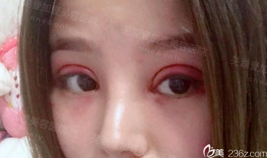 在蕪湖壹加壹做眼部失敗修復(fù)術(shù)后當(dāng)天效果 在蕪湖壹加壹做眼部失敗修復(fù)術(shù)后當(dāng)天效果