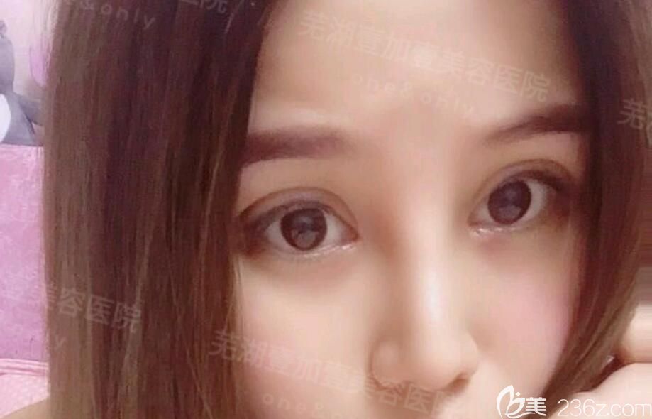 蕪湖壹加壹雙眼皮失敗修復(fù)術(shù)后第9天恢復(fù)情況 蕪湖壹加壹雙眼皮失敗修復(fù)術(shù)后第9天恢復(fù)情況