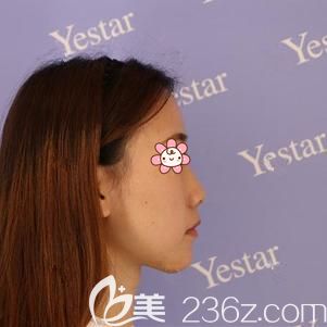 到武漢藝星面診前山根低鼻子塌的自己 到武漢藝星面診前山根低鼻子塌的自己