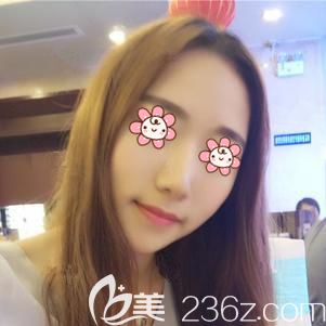 做膨體隆鼻術后9天鼻子腫脹消除 做膨體隆鼻術后9天鼻子腫脹消除