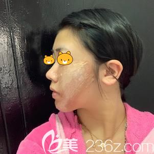 <!--<i data=20240703-sp></i>-->主任幫我做埋線提升術(shù)后即刻面部松弛改善