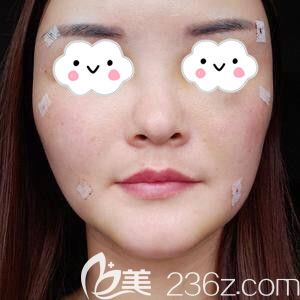 在星雅做面部脂肪填充術(shù)后3天照 在星雅做面部脂肪填充術(shù)后3天照