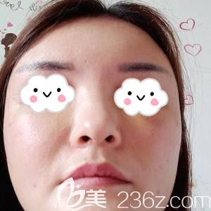 在長沙星雅做自體脂肪填充面部術(shù)后6天照 在長沙星雅做自體脂肪填充面部術(shù)后6天照