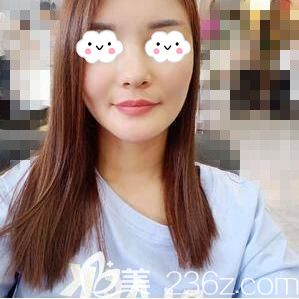 找長沙星雅李雯院長做自體脂肪填充全臉術(shù)后30天恢復(fù)效果圖 找長沙星雅李雯院長做自體脂肪填充全臉術(shù)后30天恢復(fù)效果圖