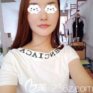 找長沙星雅醫(yī)療美容李雯做自體脂肪填充全臉術(shù)后50天效果圖分享