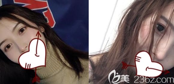 在長春中妍整形做完肋軟骨隆鼻拆線后的即刻照