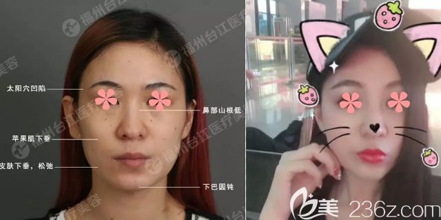 察博士自體脂肪填充面部案例對比圖 察博士自體脂肪填充面部案例對比圖