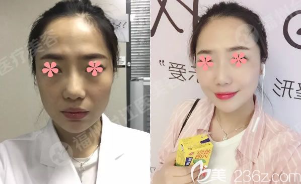 福州名韓察鵬飛自體脂肪填充全臉對比照片 福州名韓察鵬飛自體脂肪填充全臉對比照片