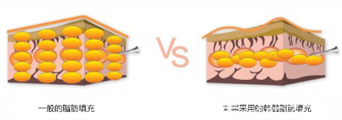 廣州紫馨梁進(jìn)華醫(yī)生自體脂肪注射技術(shù)優(yōu)勢 廣州紫馨梁進(jìn)華醫(yī)生自體脂肪注射技術(shù)優(yōu)勢