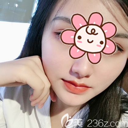 深圳潤澤瑞尼絲人中縮短術(shù)術(shù)后一個月案例照片 深圳潤澤瑞尼絲人中縮短術(shù)術(shù)后一個月案例照片