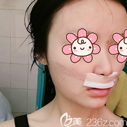 人中縮短術(shù)術(shù)后第二天效果圖 人中縮短術(shù)術(shù)后第二天效果圖